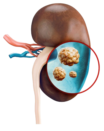 Kidney Stones