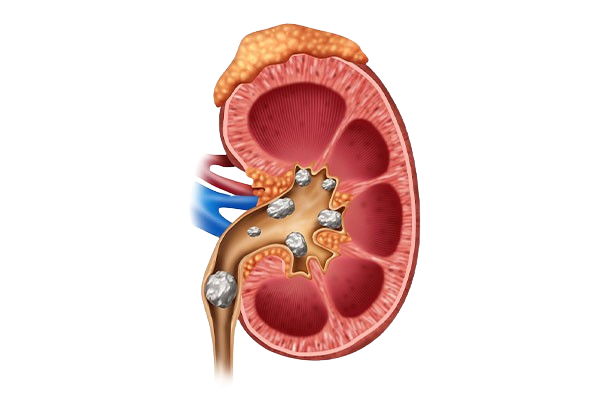 Kidney Stones